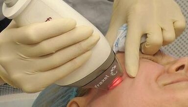 Kako se izvodi frakcijsko pomlađivanje kože