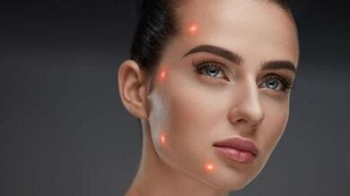 Što je frakcijsko pomlađivanje kože