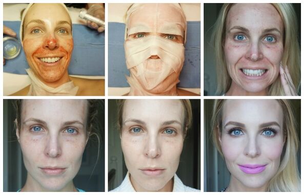 Faze cijeljenja kože lica nakon uspješnog plazma liftinga