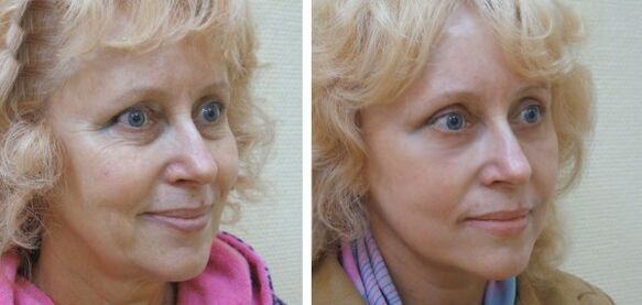 Žena prije i poslije plazma pomlađivanja kože lica
